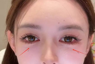 33岁叶珂真实状态曝光！医美后遗症好明显
