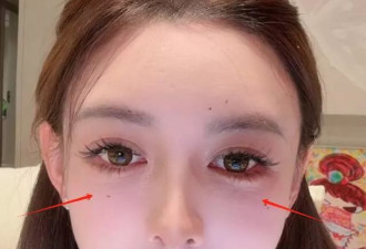 33岁叶珂真实状态曝光！医美后遗症好明显
