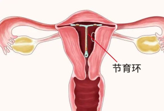 中国第一批“上环”的女性 40年后现状如何？
