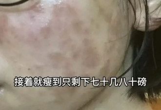 TVB前女星转行直播带货！自曝患病身上没一块好肉