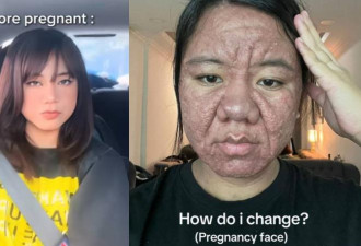 对比惊人！28岁孕妇皱纹暴增“脸”像老人