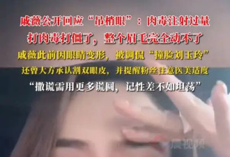 戚薇自曝打肉毒打僵了眉毛完全动不了！提醒大家医美需谨慎
