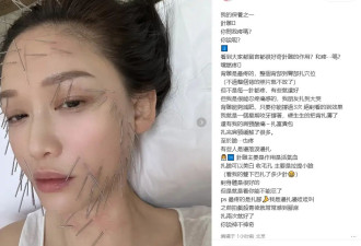 今夏走红！满脸扎上百根细针受追捧？上海三甲医院就有，真实体验出人意料！提醒→