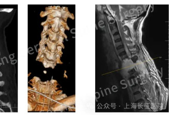 全球罕见！中国医生救回“身首离断”患者
