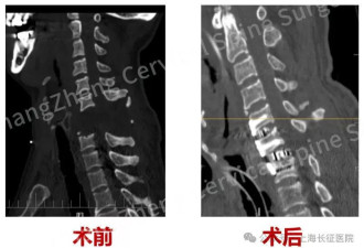 全球罕见！“身首离断”患者被救回
