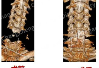 “身首离断”被救回引关注！主刀医生讲述从医30多年最凶险情况
