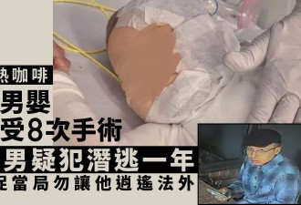 澳男婴被中国男严重烫伤1周年：已8次手术 母亲促…