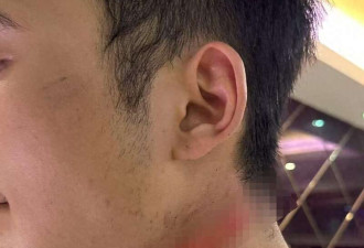 男主播骑车被路边掉落网线勒伤脖子索赔陷僵局