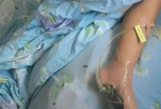6岁男孩海边赤脚玩耍 踩到死鱼后发烧进ICU
