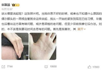 伸懒腰“手掌流血”? 张靓颖自曝患病 已开始惜命