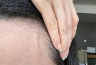 伸懒腰“手掌流血”? 张靓颖自曝患病 已开始惜命