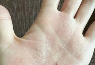 伸懒腰“手掌流血”? 张靓颖自曝患病 已开始惜命