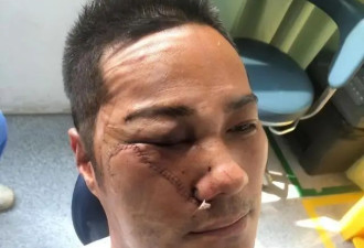 香港知名男星被砍留后遗症 脸皮险被砍掉 身上多处刀疤清晰可见
