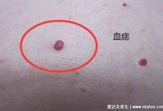 三个症状说明有肝癌了