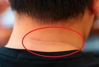 注意：皮肤这6种变化，可能是“癌症”信号