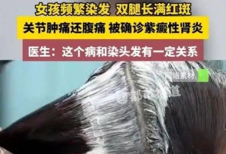 太疯狂！00后女生频染发双腿长满红斑 确诊肾炎