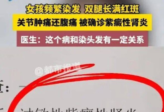 太疯狂！00后女生频染发双腿长满红斑 确诊肾炎