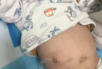 试管婴儿出生不久确诊肾病综合征：医院被判担责10%