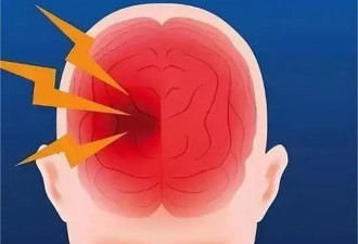脑干一旦出血 死亡率竟高达50%