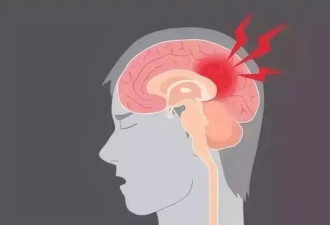 脑干一旦出血 死亡率竟高达50%
