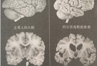 经常说这4句话的人，痴呆倾向高于同龄人