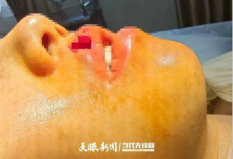 女子上门代喂，被100多斤阿拉斯加犬咬伤遭毁容