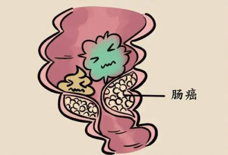 我还年轻 不会得肠癌？3类症状别忽视