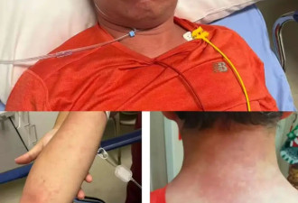 协和专家吃头孢遇险，“我成了被抢救的人”