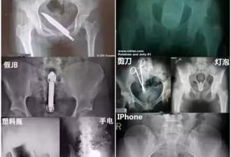 腚腚历险记:为什么说肛肠科大夫见多识广?