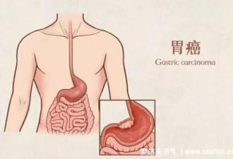 女性胃癌早期有三处痛