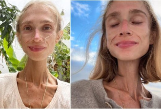瘦成骷髅！素食女“只吃水果”活活饿死