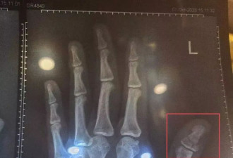 纪录：一个外卖骑手耗时661天的工伤维权