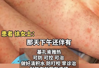 基孔肯雅热确诊超2万例，一个重症都没有