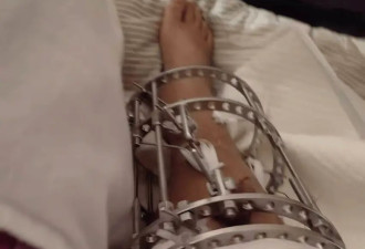 河南一患者“断骨增高致瘸”追踪:医院及科室遭罚