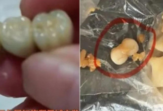 人肉叉烧包？中国女子吃香肠竟咬出3颗牙齿