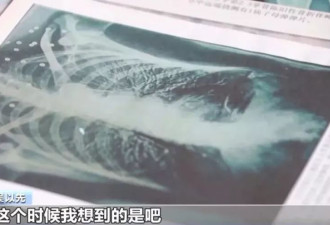 "老先生，您把项链取下来再做CT""你看是不是弹片"