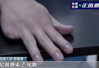 缅甸诈骗园残忍手段：竹片挑断手筋 剁手指浸酒