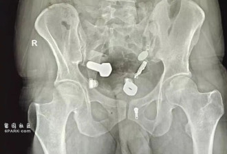 男子腹痛 医生惊了 手表卡食道 大肠塞螺栓...
