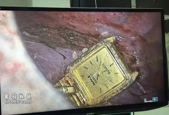 男子腹痛 医生惊了 手表卡食道 大肠塞螺栓...