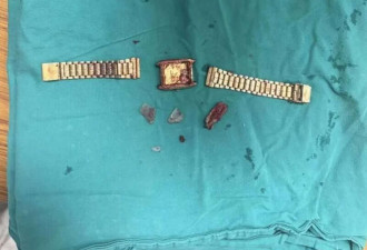 男子腹痛 医生惊了 手表卡食道 大肠塞螺栓...