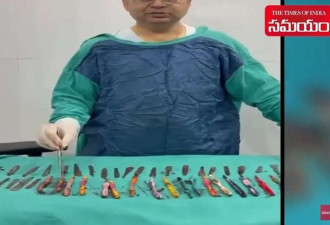 男子腹痛 医生惊了 手表卡食道 大肠塞螺栓...