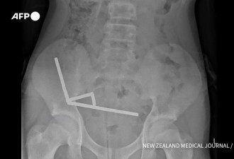 纽西兰男童吞食百块磁铁 组织坏死切除部分肠道