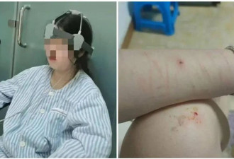 被篮球砸中头部后 13岁少女的噩梦开始了…