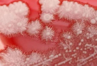 中国男子感冒乱吃药 喉咙长满雪花 吓坏医生