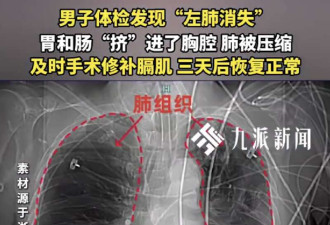 男子中奖获体检 发现左肺不见了 无明显不适