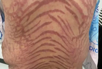 号称治百病！40岁女狂擦“网红神药”全身布满蛇纹 医师揭惊人成分