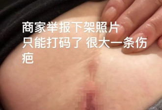 王祖贤艾灸馆翻车？华人花$600被烫出大水泡