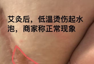 王祖贤艾灸馆翻车？华人花$600被烫出大水泡