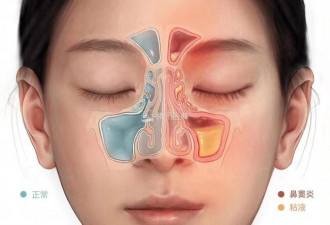 别误把鼻窦炎当感冒 5分钟精准分辨