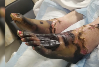 致命感染爆发! 加拿大女子8天内四肢坏死被迫截肢! 健康人也中招